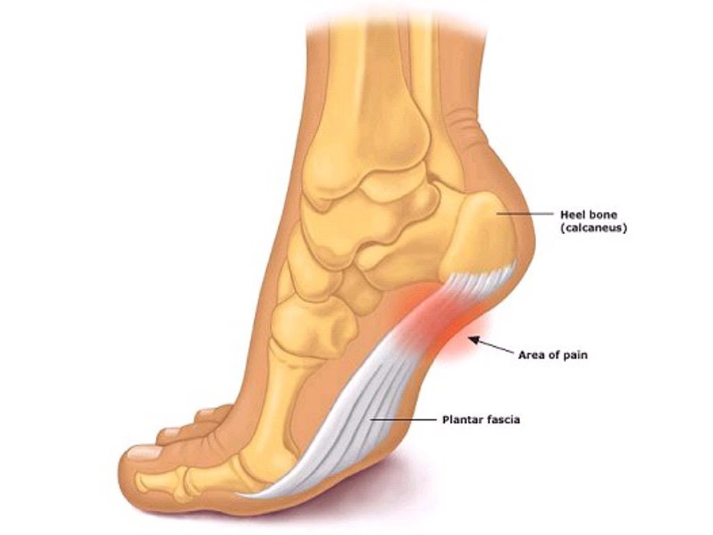 plantar fasciitis in one heel